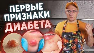 5 главных признаков диабета / Как понять, что у вас ПРЕДДИАБЕТ?