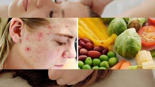 These Foods Can Kill Your Acne | Multi-Language Subs | FSP